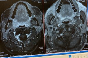 造影MRI2　中咽頭がん